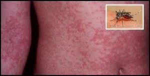 Causa alarma en Haití por presencia del zika