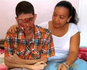 Joven dominicano pierde su rostro debido a un cáncer