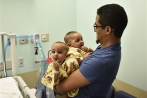 Separan siamesas dominicanas en una larga operación en Nueva York