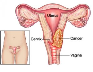El cáncer de cervix es totalmente prevenible