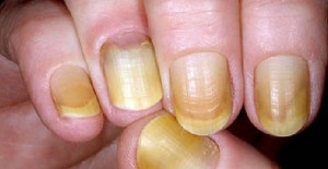 Síndrome de uñas amarillas