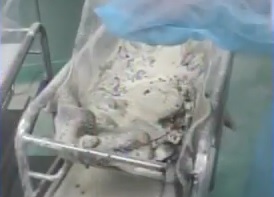 Fallece bebé resultó con quemaduras por explosión bombilla en hospital SD