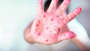 NUEVA JERSEY: Alertan de exposición a sarampión