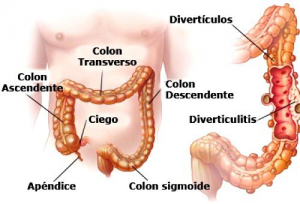 Explican dieta para diverticulitis Explican dieta para diverticulitis
