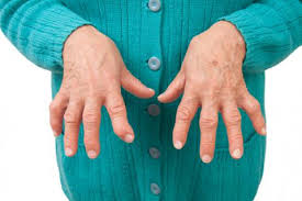 FUNDERIC exhorta sensibilizar sobre Artritis Reumatoide