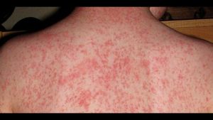 Salud intensificará vacunas contra el sarampión en todo el país