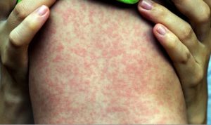 Enfermedad del sarampión se extiende en Nueva York