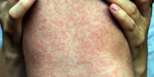 En lo que va de 2019, aumentaron 300% los casos de sarampión en el mundo En lo que va de 2019, aumentaron 300% los casos de sarampión en el mundo