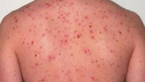 Sarampión sigue extendiéndose en Nueva York; hay ya 466 casos