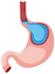 Sugerencias médicas para enfrentar el molestoso reflujo ácido