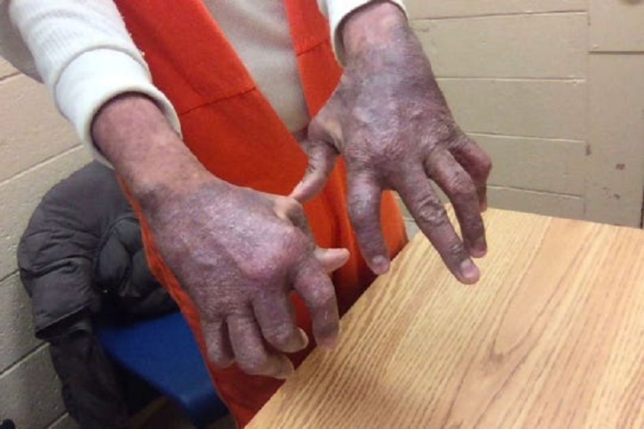 Dominicano demanda a Inmigración por lesiones durante encierro imagen