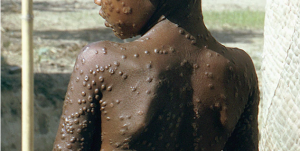 ¿Qué sabe usted de la viruela?; vacunación terminó en el 1970 ¿Qué sabe usted de la viruela?; vacunación terminó en el 1970