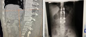 Cirujanos hospital Salvador Gautier operan mujer sufrió fractura columna