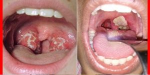 Ministro de Salud confirma detectaron 19 casos de difteria con 10 fallecidos