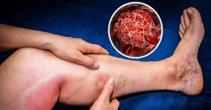 Citan incidencia de la trombosis Citan incidencia de la trombosis