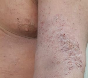 La dermatitis atópica es controlable en niños