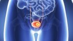 Oncóloga afirma cáncer de cérvix es altamente prevenible y tratable