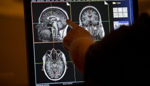 Cleveland Clinic lanza novedoso estudio sobre males cerebrales