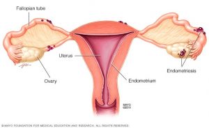 La endometriosis afecta a 1 de cada 10 mujeres en el mundo