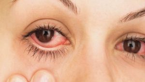 Cómo prevenir alergias oculares; se incrementan en primavera