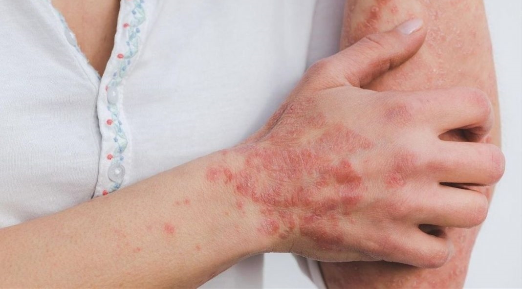 SP emite alerta epidemiológica por «sarna» detectada en Haití imagen