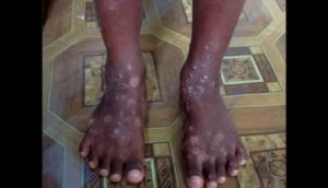 Haití advierte sobre enfermedad de la piel «altamente contagiosa»
