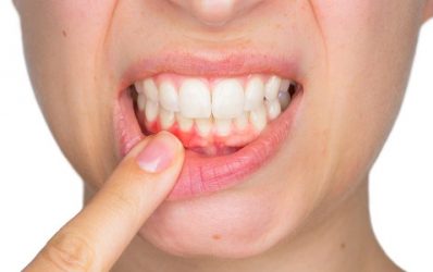 Mala salud periodontal contribuye a mayor depresión y ansiedad