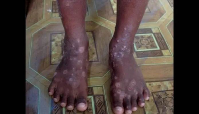Haití advierte sobre enfermedad de la piel "altamente contagiosa" -  AlMomento.Net