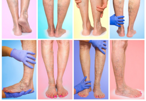 ¿Pueden las venas varicosas causar dolor en la pierna?