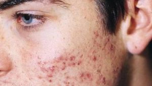 Consejos médicos para el acné y el cuidado diario de nuestra piel