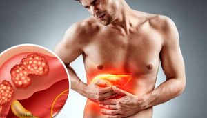 Casos y muertes por cáncer de hígado aumentarán 55% a 2040 Casos y muertes por cáncer de hígado aumentarán 55% a 2040