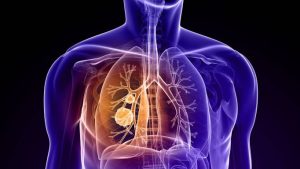 En Latinoamérica es tardío 85% diagnósticos cáncer de pulmón