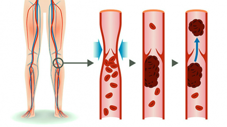 Tratan con éxito en Santo Domingo casos enfermedad arterial periférica Tratan con éxito en Santo Domingo casos enfermedad arterial periférica