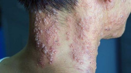 Estudio explica por qué el herpes zóster puede provocar un ictus Estudio explica por qué el herpes zóster puede provocar un ictus