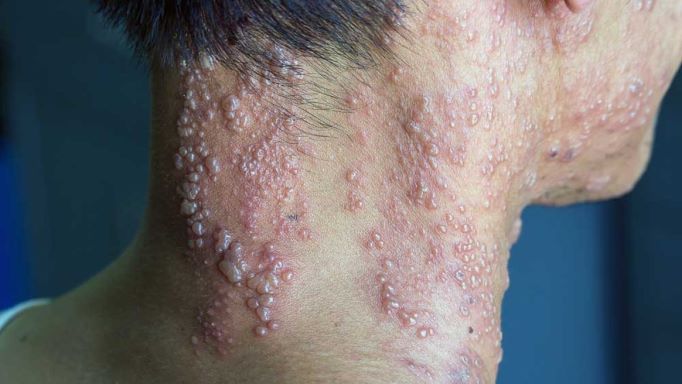 what-you-need-to-know-about-herpes-or-hsv-healthsoul