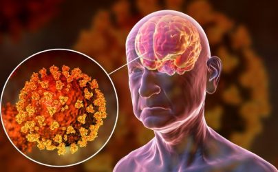 Estudio relaciona alteraciones cerebrales con el covid persistente Estudio relaciona alteraciones cerebrales con el covid persistente