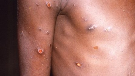 Identifican una nueva forma severa de la viruela del mono Identifican una nueva forma severa de la viruela del mono