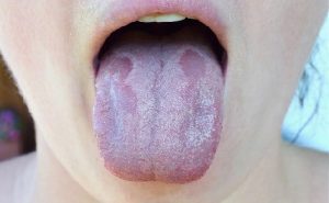 El color de la lengua puede ser determinante para su salud