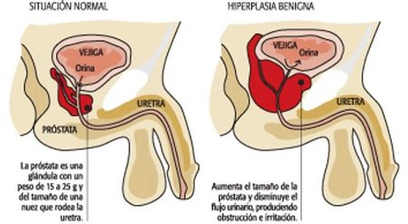 Reduce tu próstata agrandada y mejora el flujo de orina Reduce tu próstata agrandada y mejora el flujo de orina