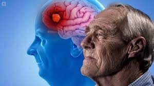 ¿Cómo saber si una persona tiene alzheimer?: Conoce los síntomas