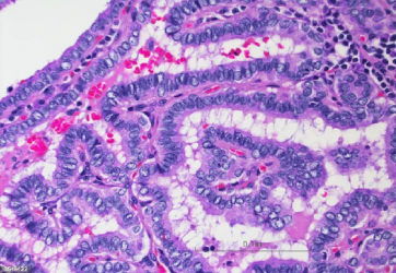 El carcinoma papilar es tres veces más común en las mujeres