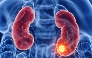 Tres mil muertes al año por causa del cáncer renal en Centroamérica