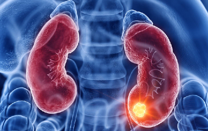 Tres mil muertes al año por causa del cáncer renal en Centroamérica imagen