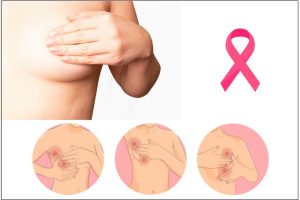 85% mujeres con cáncer de mama sobreviven 5 años tras diagnóstico