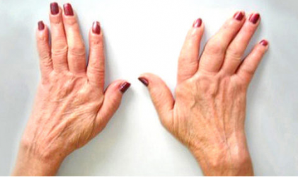 Mil millones de personas sufrirán osteoartritis en 2050, dice estudio