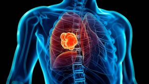 El cáncer de pulmón mataría más de 160.000 latinos en una década