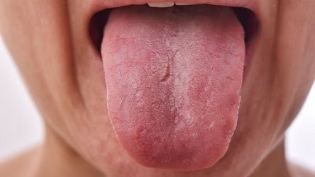 Advierten estado de la lengua puede reflejar enfermedades
