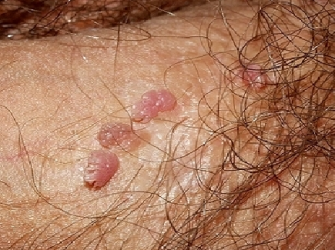 Haití anuncia campaña de vacunación contra el papiloma Haití anuncia campaña de vacunación contra el papiloma