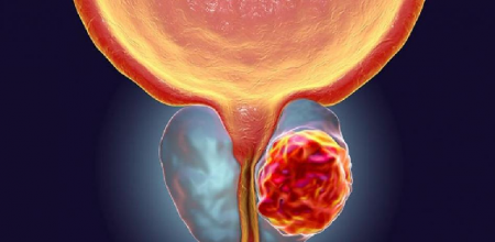 Contaminación del aire puede aumentar riesgo cáncer de próstata