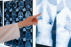 Ocho síntomas que pueden alertar de un cáncer de pulmón temprano